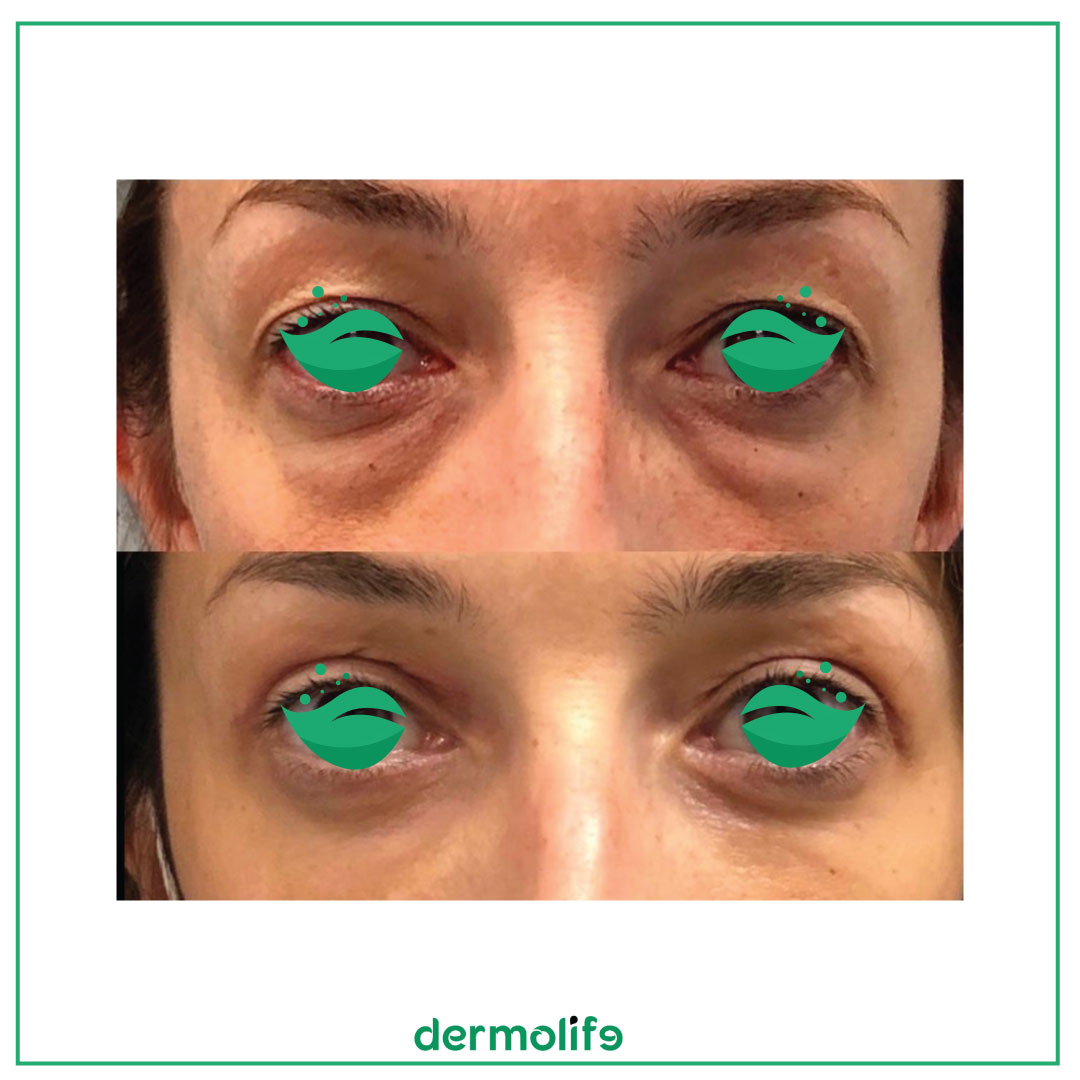 Blefaroplastika e syve