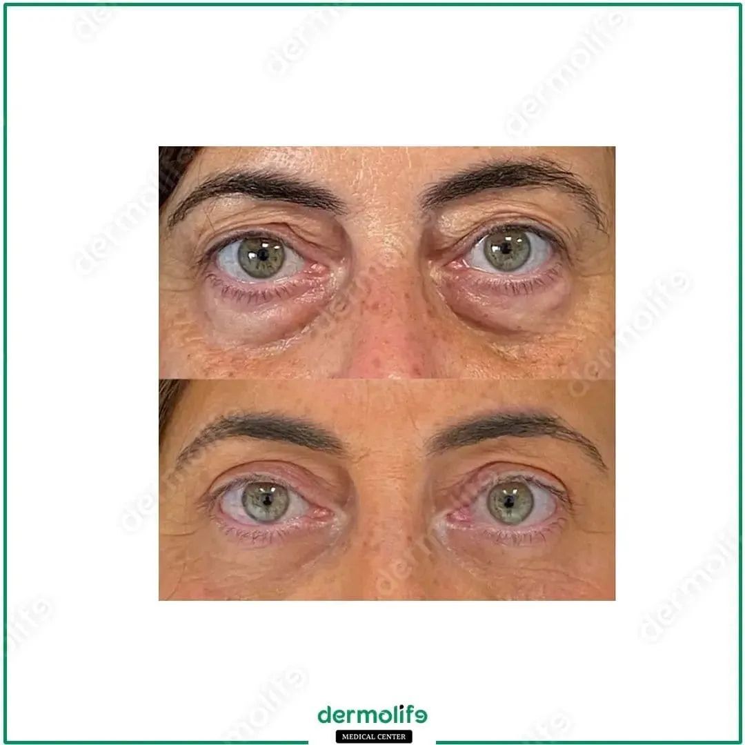 operacioni i qeseve te syrit pamja 4 dermolife