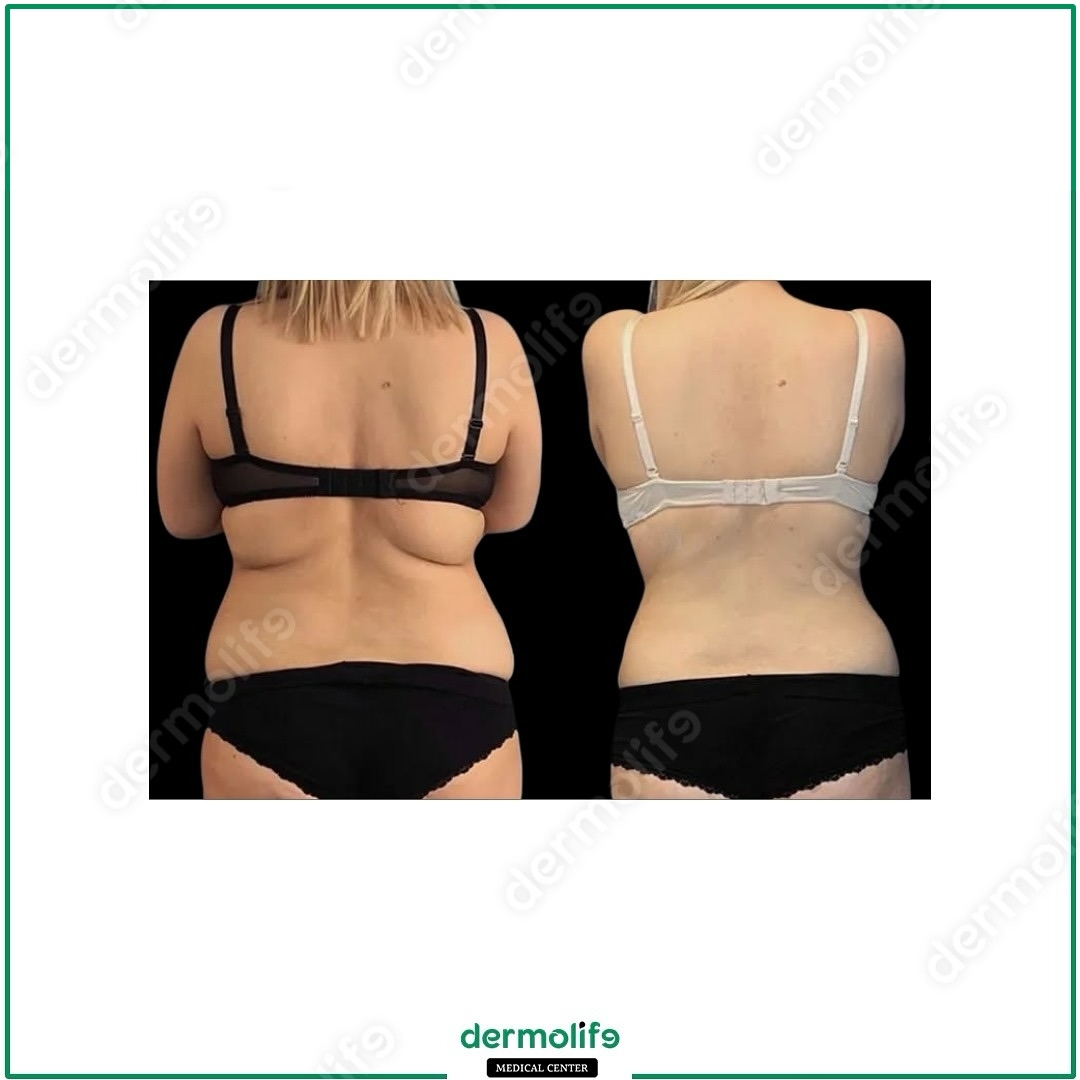 liposkulptura pamja 32