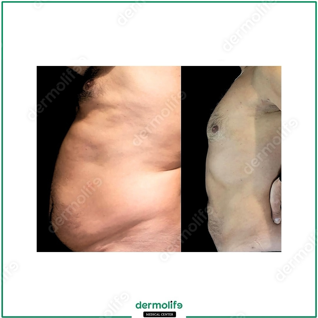 liposkulptura pamja 44