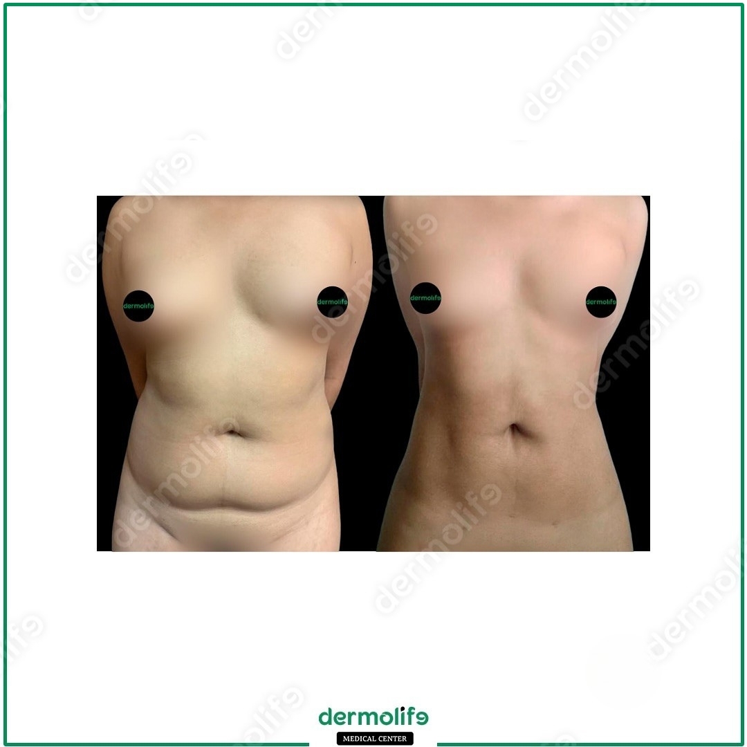 liposkulptura pamja 2222
