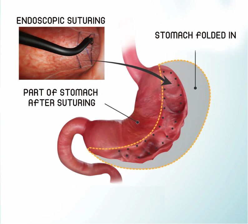 Cfare eshte gastroskopia