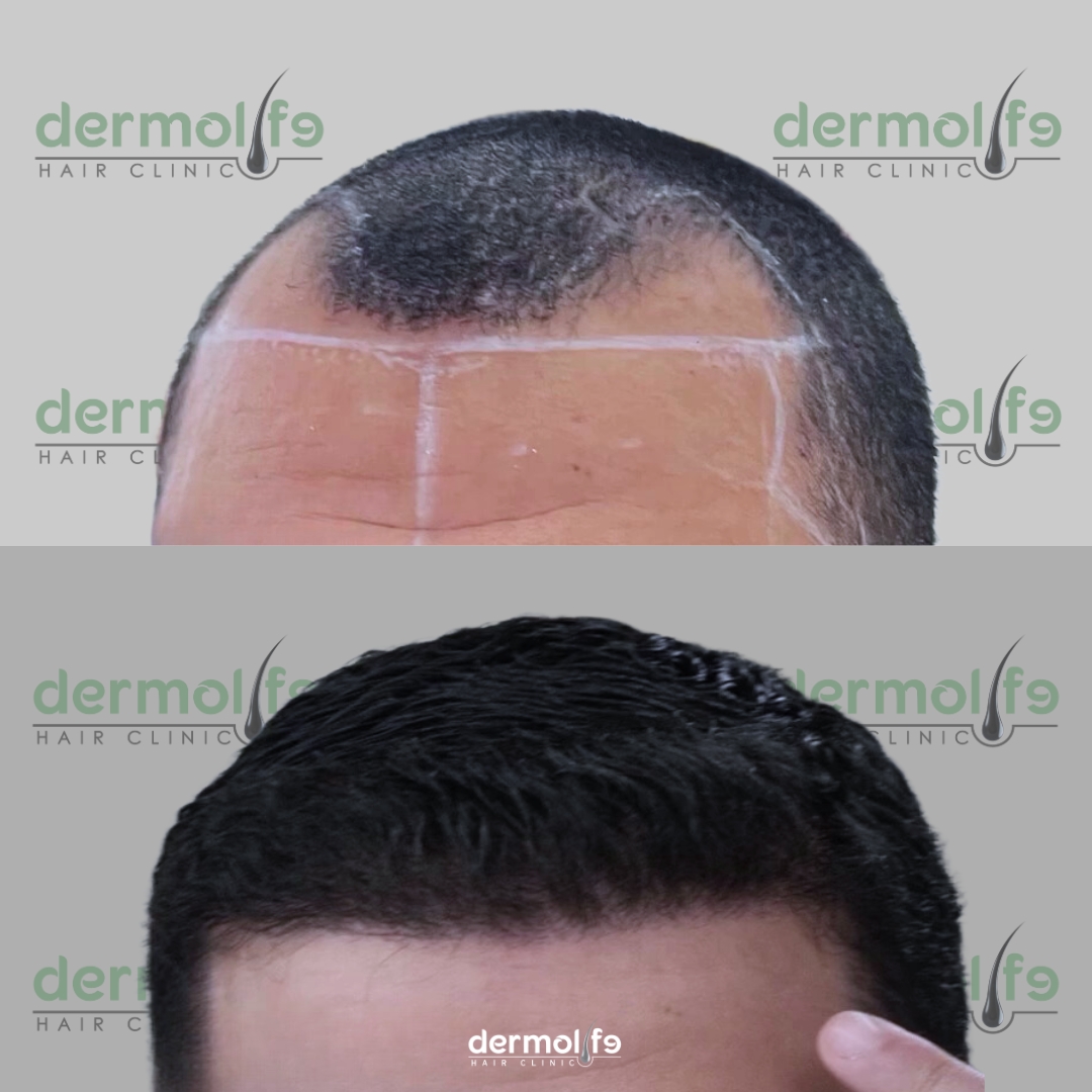 Mbjellja e Flokeve 2 Micro Fue Implanter Pen ne Dermolife