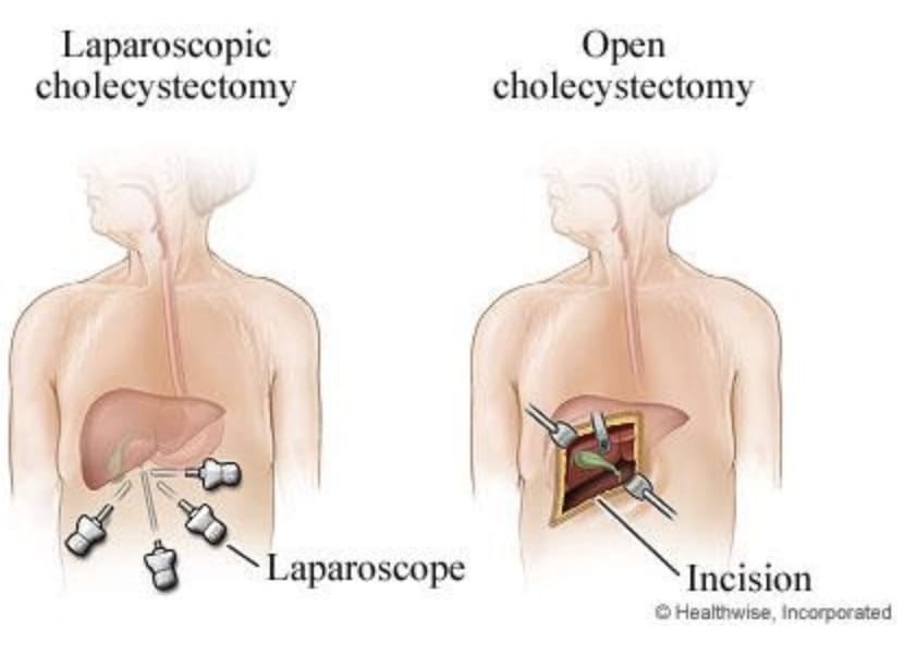 laparoskopike